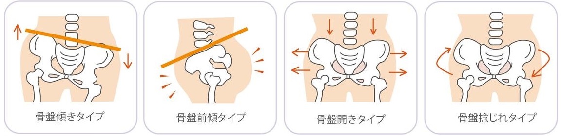 ゆがみのタイプ